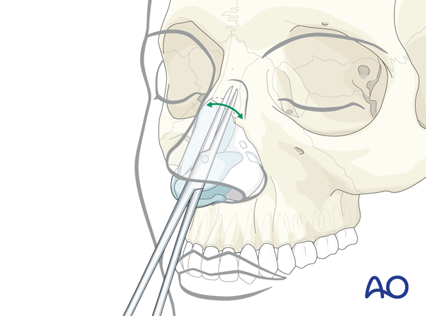 Exposure of the bony nasal dorsum – external rhinoplasty approach (open)