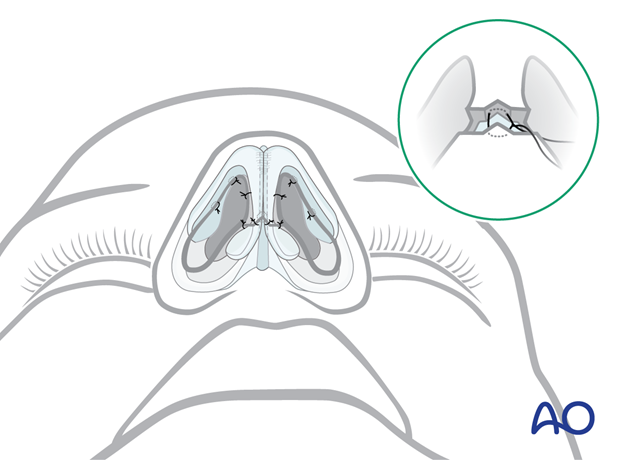 Wound closure – external rhinoplasty approach (open).