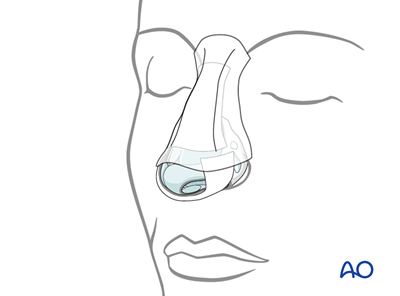 External rhinoplasty approach (open)