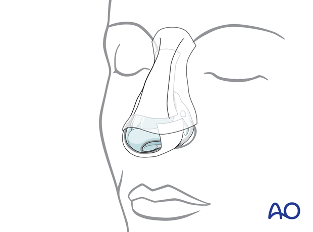 External dressing – external rhinoplasty approach (open).