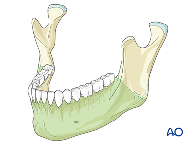 Transoral approach to the symphysis and body