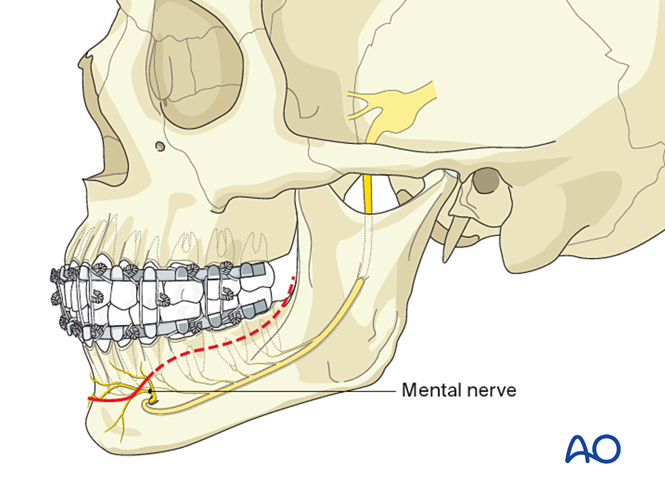 Transoral approach to the symphysis and body