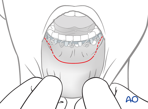 Incision line for the transoral approach to the symphysis