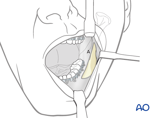 Make an incision through the mucosa in the vestibule