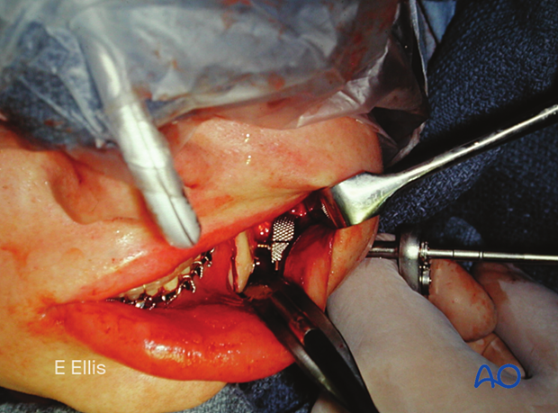 The transbuccal trocar may also assist the surgeon in positioning posterior and inferior screws