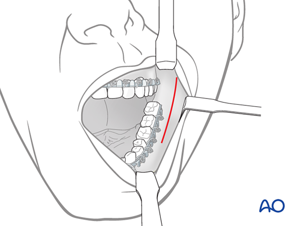 Vestibular incision