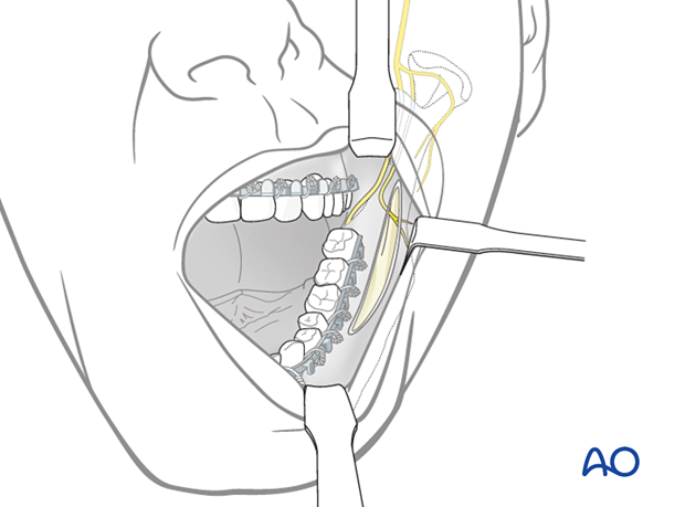 Make an incision through the mucosa in the vestibule