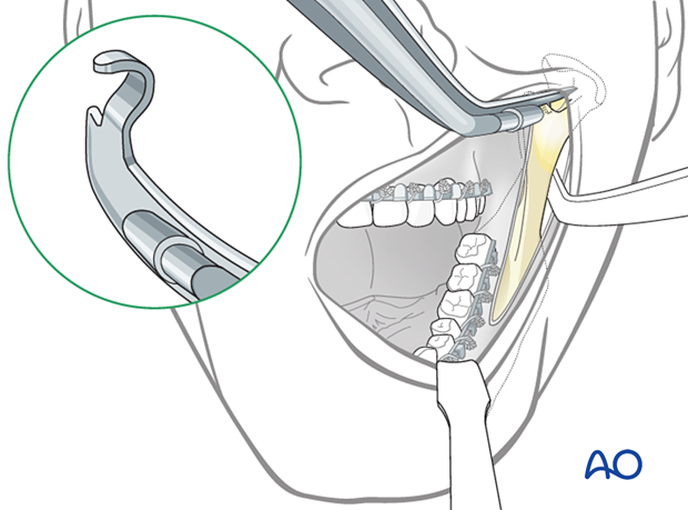 The fixation can be done either by transbuccal or right-angled instrumentation