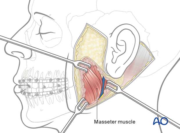 Bluntly dissect the parotid gland from the underlying masseter muscle