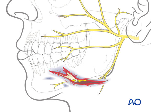 Involvement of the facial nerve