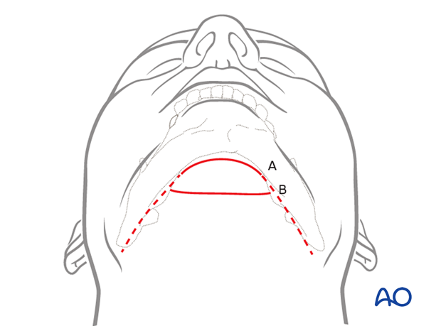 submental approach