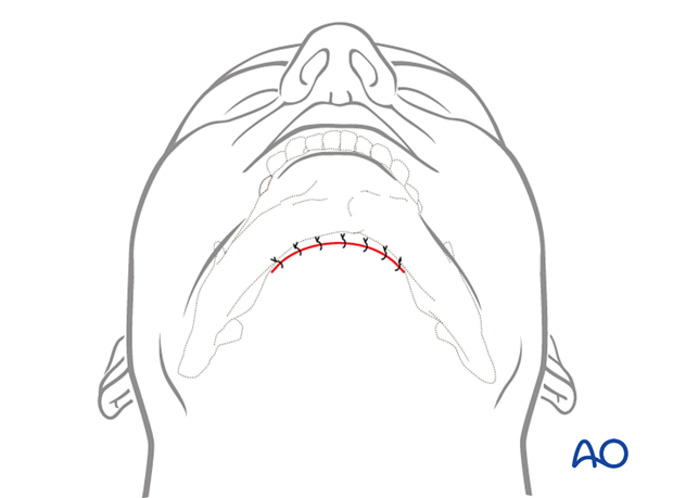 The wound is closed in layers to realign the anatomic structures