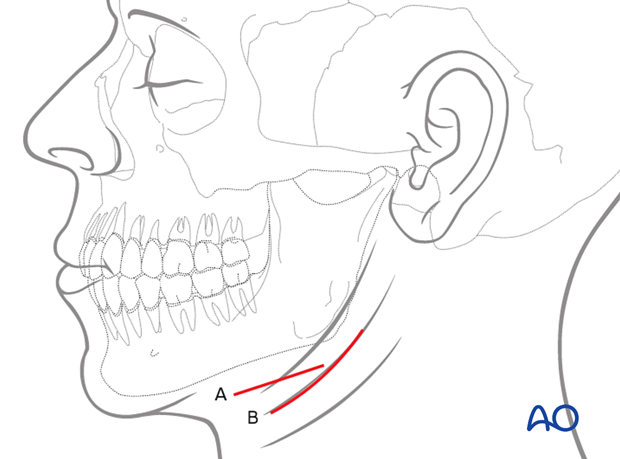 The incision can either be parallel to the inferior border of the mandible (A) or be placed in an existing skin crease (B) for maximum cosmetic benefit