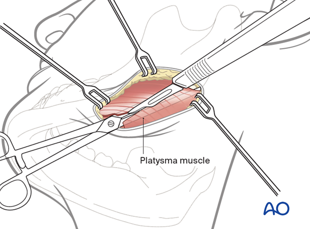 The platysma muscle is divided sharply, preferably 2-3 cm below the mandibular border, not necessarily at the same level of the skin incision