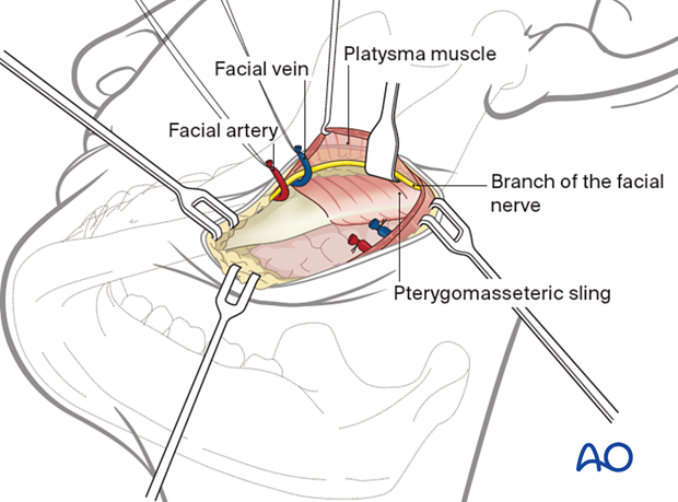 Ligation of facial artery and vein