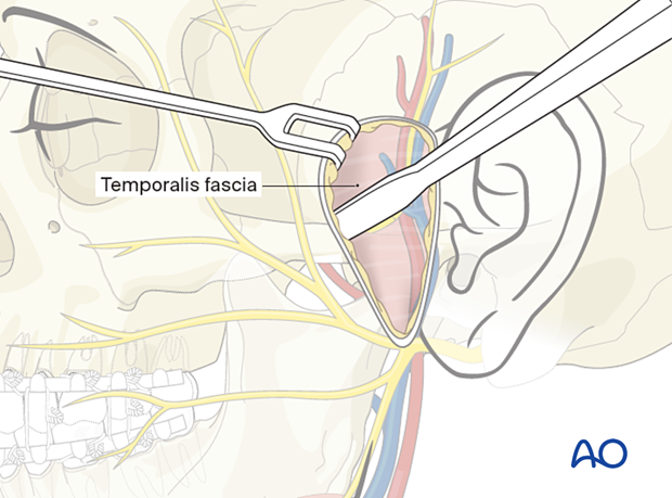 The incision to the depth of the temporalis fascia