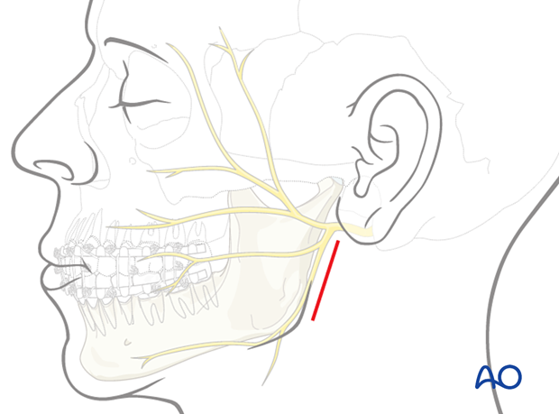 The main anatomic structures in this approach are the main trunk and branches of the facial nerve and the retromandibular vein
