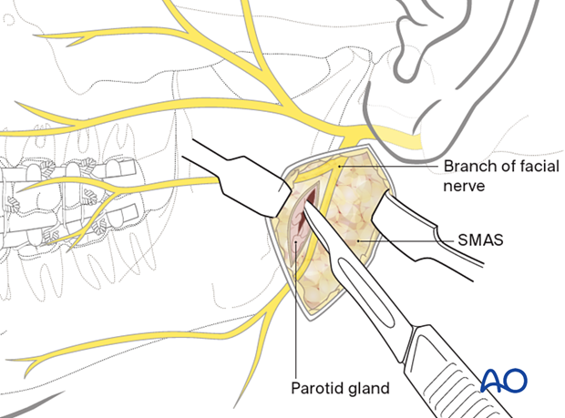 Vertical incision into the parotid gland