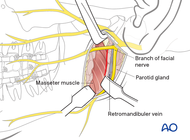 Dissection of the parotid gland parallel to the direction of the facial nerve branches