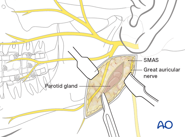 The posterior aspect of the parotid gland is identified, and dissection continues behind the gland