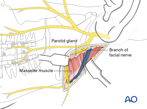 The gland is lifted off the masseter muscle and retracted anteriorly
