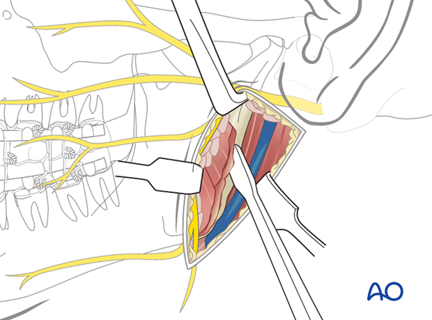 A periosteal elevator is used to strip the masseter muscle from the ramus