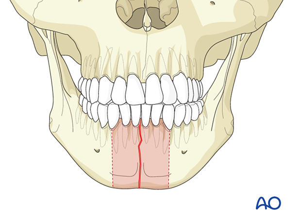 These are simple fractures in the area between the canine teeth of the mandible. 