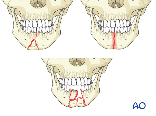 These are complex fractures in the area between the canine teeth of the mandible.  