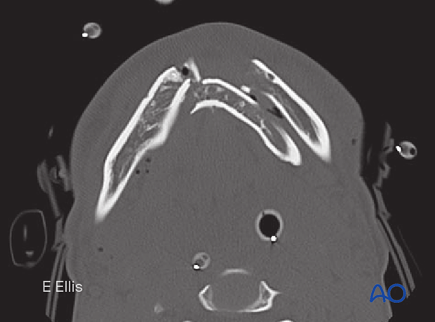This image shows an axial CT view of a comminuted symphyseal fracture.