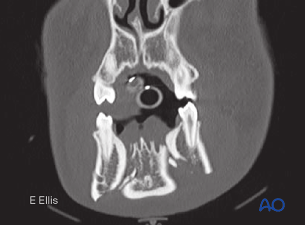 This image shows a coronal CT view of the same case.