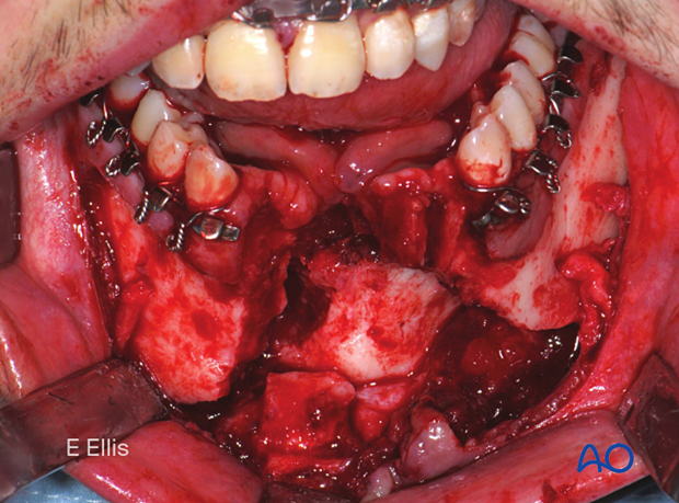 This is the clinical photograph of the same case.