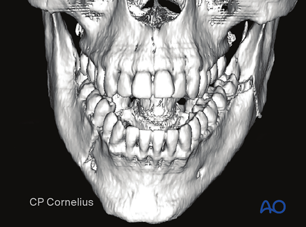 This 3-D reconstruction shows a simple right anterior body fracture with an associated left mandibular angle fracture. 