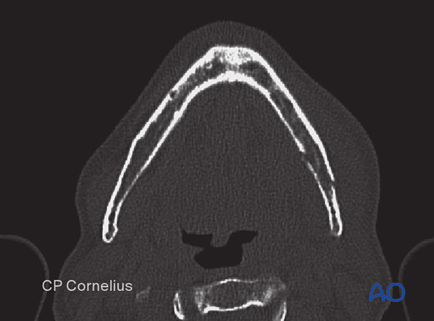 The obliquity of this fracture is again noted in this axial CT. 