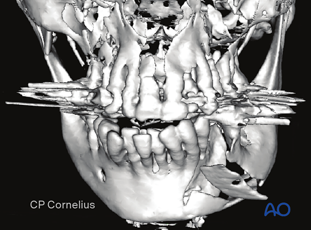 This 3D-CT shows the PA view of the same case.