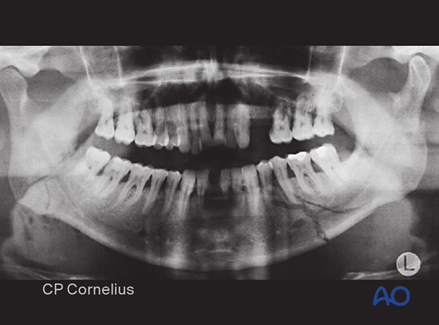 This case shows a mandibular body basal triangle fracture, which represents a lower grade of complexity.