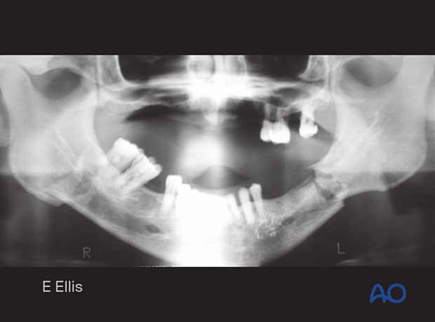 Simple fractures of the mandibular angle and ramus