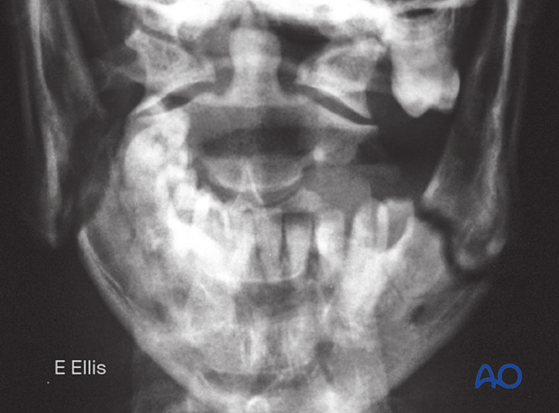 Simple fractures of the mandibular angle and ramus