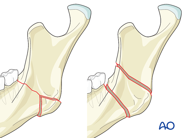 Comminuted fractures involve at least two fracture lines and three or more fragments in the same region of the mandible. 