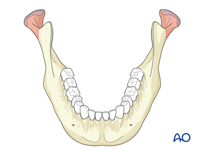 Condylar process and head - simple and complex