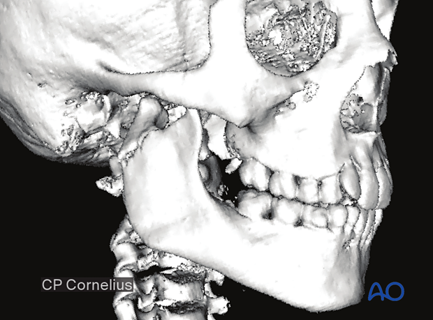 This 3D reconstruction of a CT scan illustrates a right condylar process fracture