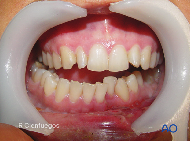 The dental occlusion 