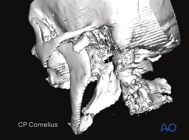 This 3-D reconstruction illustrates a (high) neck fracture with displacement