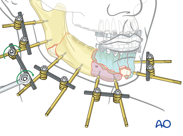 3.Tighten the rod-to-rod clamps