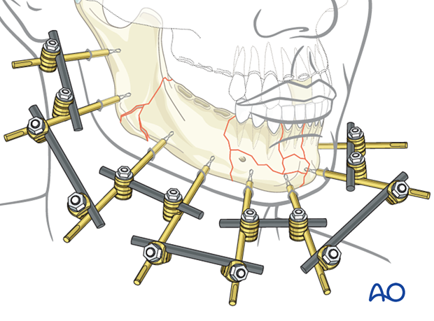 MMF is removed after the final external fixator assembly to allow for mandibular function.