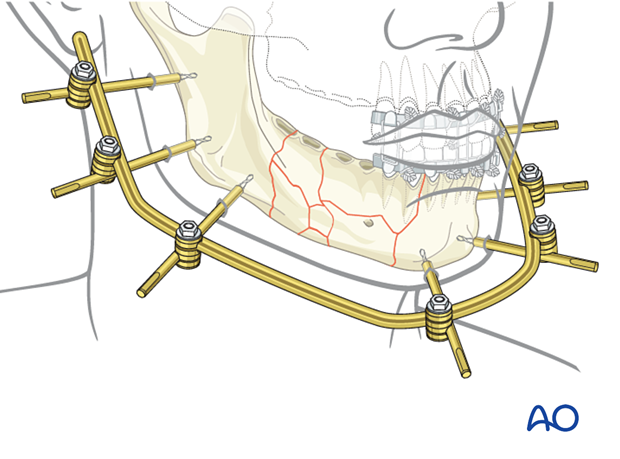 When a large circumference of the mandible requires external fixation, a pre-contoured rod can be directly attached to the pins