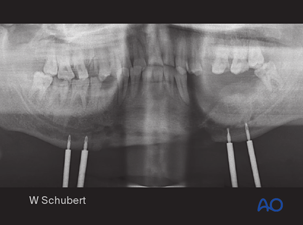 The postoperative orthopantomogram shows Schanz screws where the screw on the far left is too close to the inferior alveolar nerve.