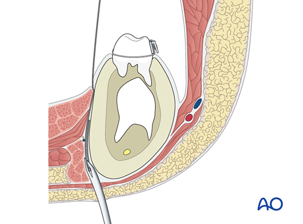 The awl is retracted to the inferior margin of the mandible…