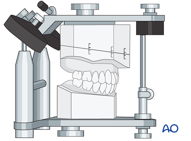 Cast model mounted in an articulator