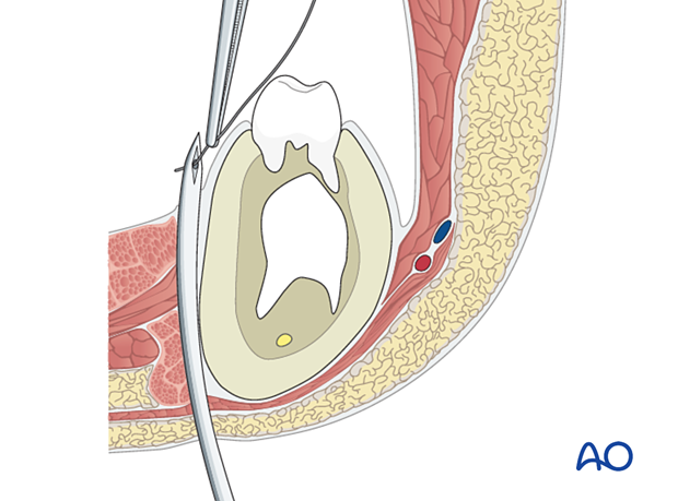An awl (or needle) is inserted in the submandibular area and passed close to the periosteum on the labial or lingual side of the mandible into the mouth
