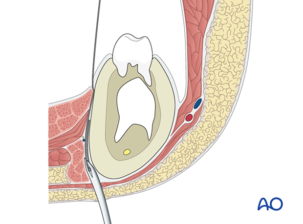 The awl is retracted to the inferior margin of the mandible…
